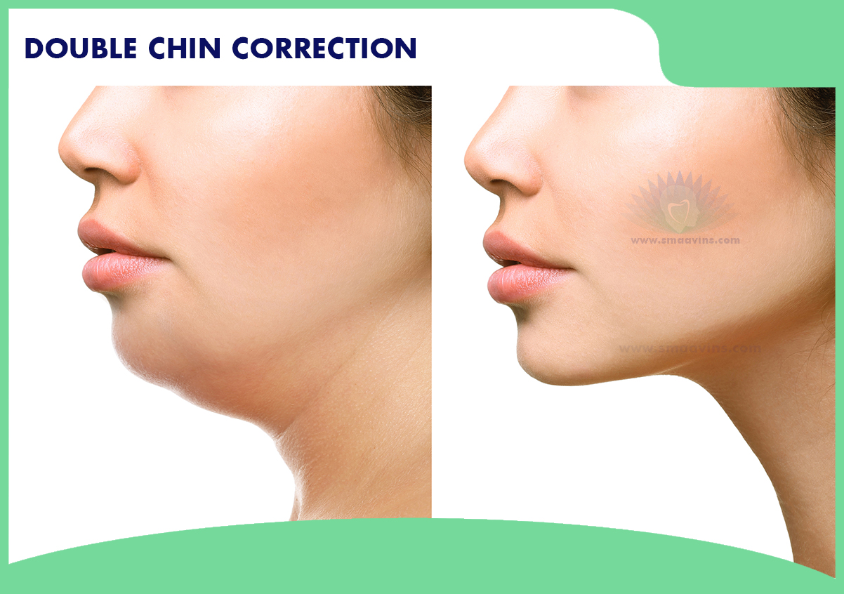 best-double-chin-correction-procedure-smaavins-chennai