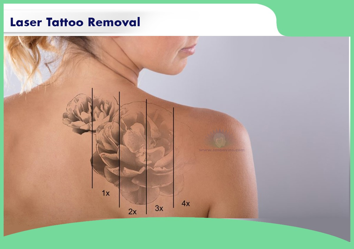 Permanent Laser Tattoo Removal Procedure  Its not possible to wake up  someday and choose to erase that permanent ink that has become a part of  the skin But if you asked