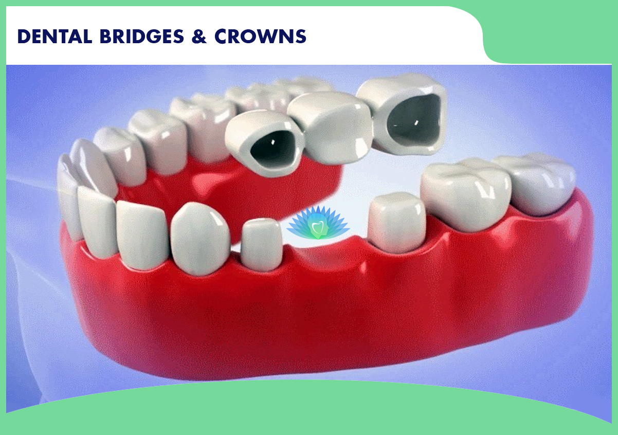 Benefits of dental BRIDGES & CROWNS