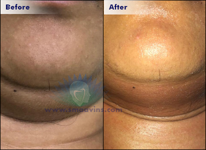 Double Chin Correction