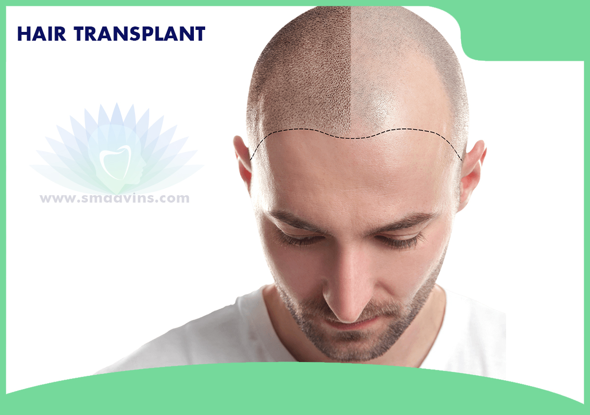 Get The Best Hair Transplant Procedure Smaavins, Chennai