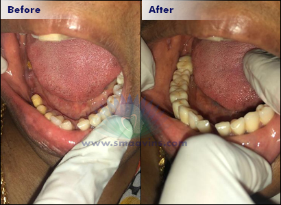 Dental Bridges