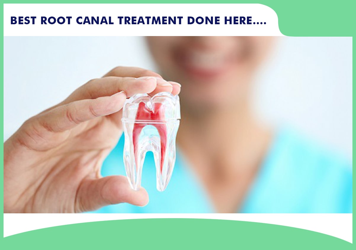 Root Canal Treatment, Best Dental Clinic