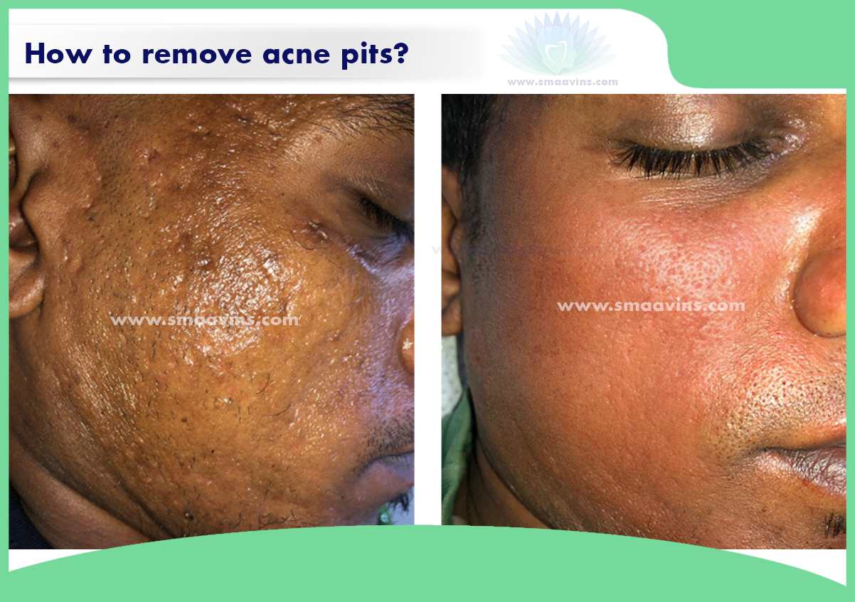 Best Acne Pits removal treatment in chennai kk nagar