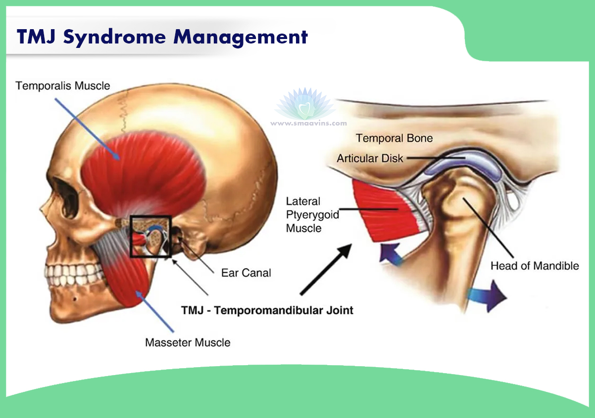 Best TMJ Syndrome Management | Smaavins, Chennai