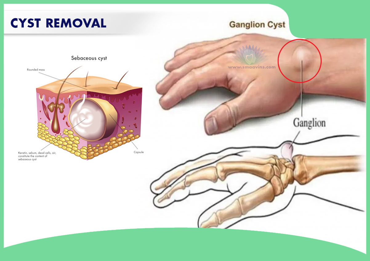 get-the-best-cyst-removal-treatment-in-chennai-at-smaavins