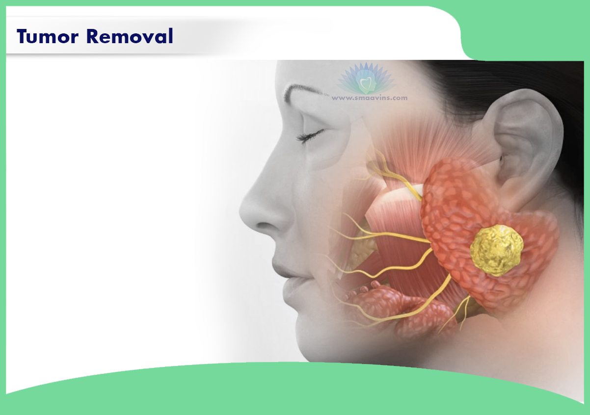 Tumor Removal In Chennai Smaavins The Best Clinic